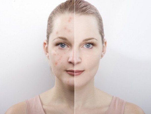 8 лучших домашних средств от прыщей